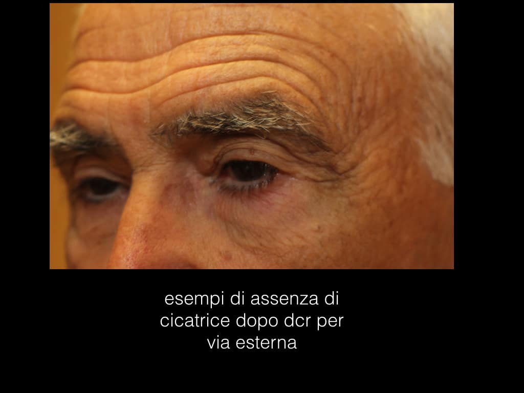Dacriocistorinostomia intervento per lacrimazione occhi