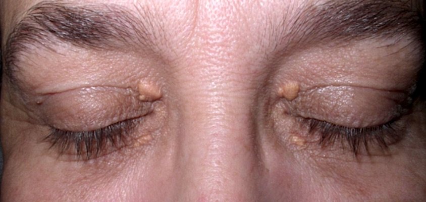 Xantelasma palpebrale. cause e cura. dr. renata migliardi Xantelasma palpebrale. Cause e Cura. Dr. Renata Migliardi