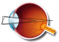 astigmatismo