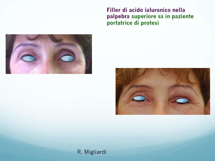 filler acido ialuronico 3