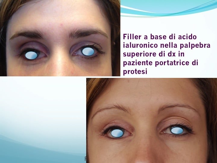 filler acido ialuronico 4