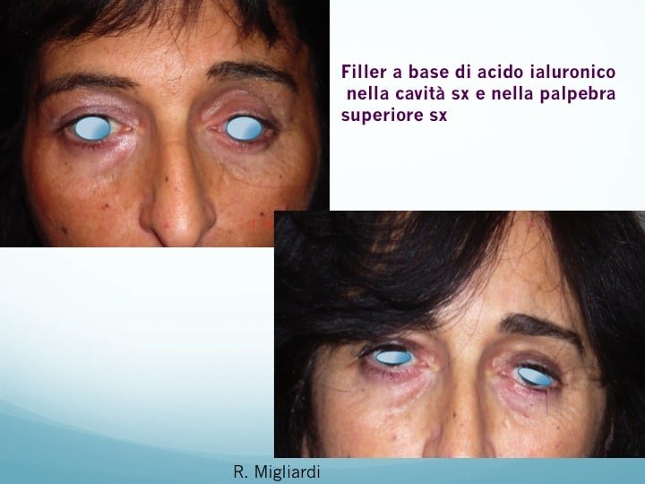 filler acido ialuronico 5