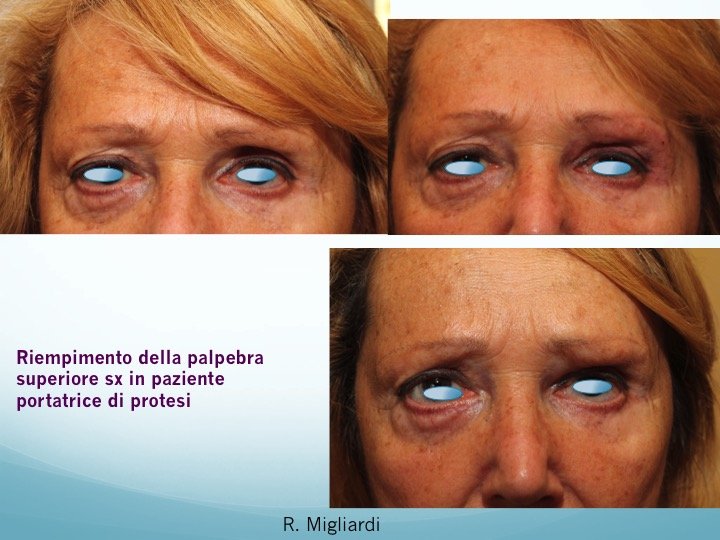 filler acido ialuronico 6