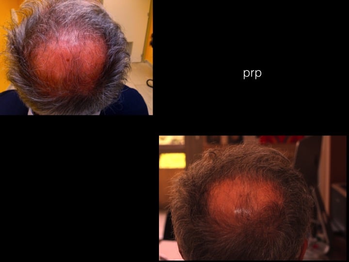 prp capelli 6