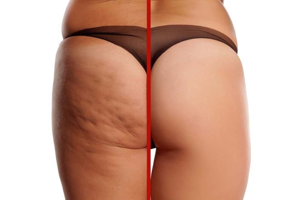 cellulite - esteticaoculare