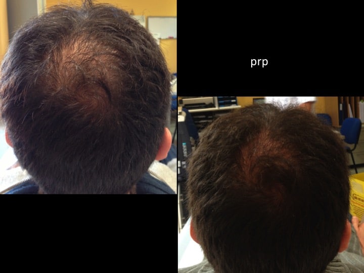 prp capelli 3