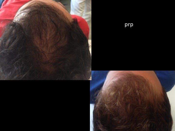 prp capelli 5