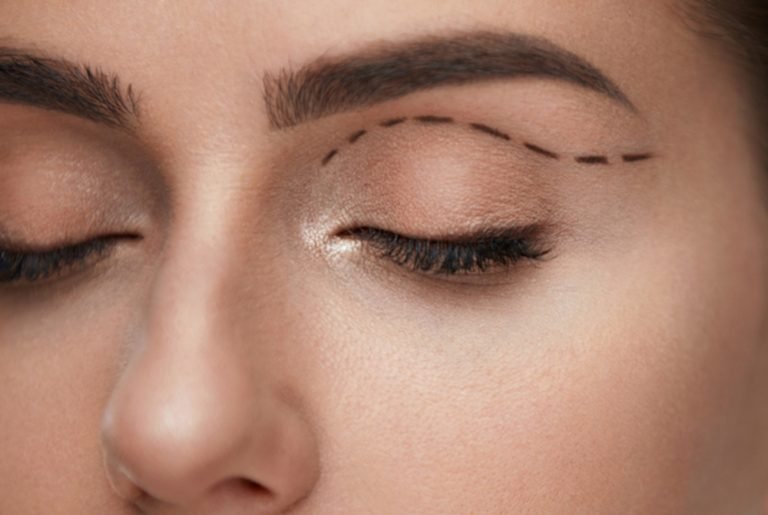 Blefaroplastica Superiore -esteticaoculare