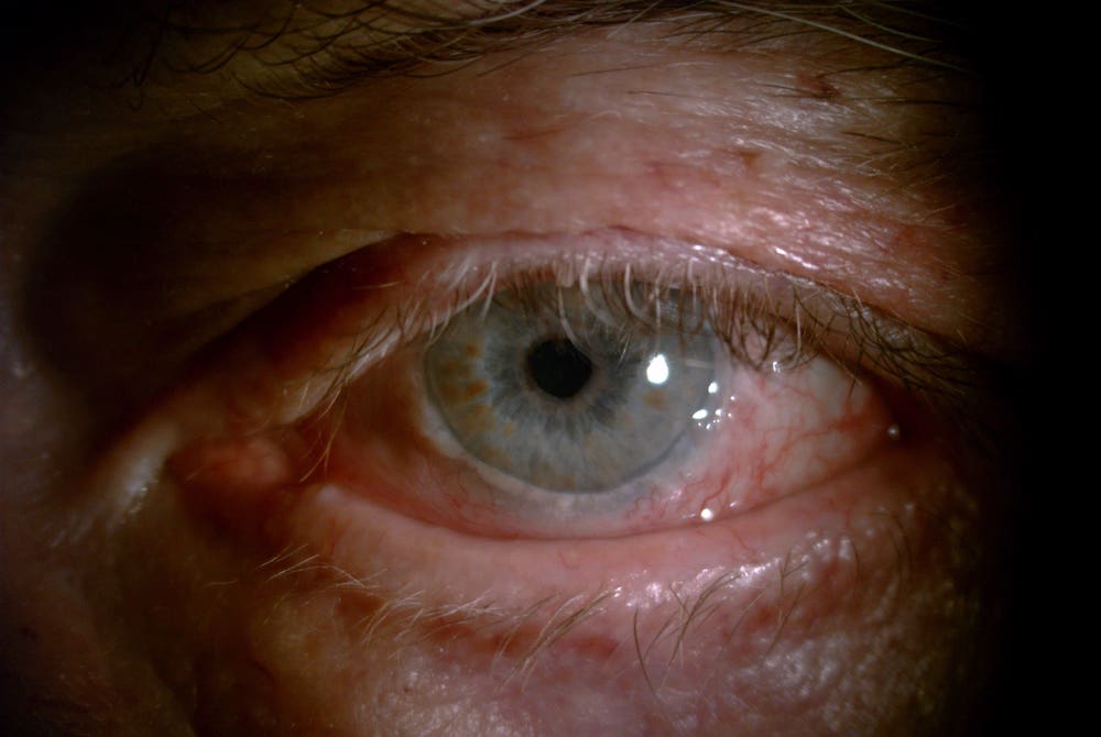 Ectropion -Dr. Renata Migliardi