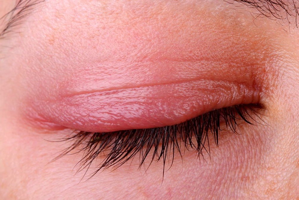 Laser frazionato lutronic mosaic Blefarite da stress • Renata Migliardi Oculista Torino