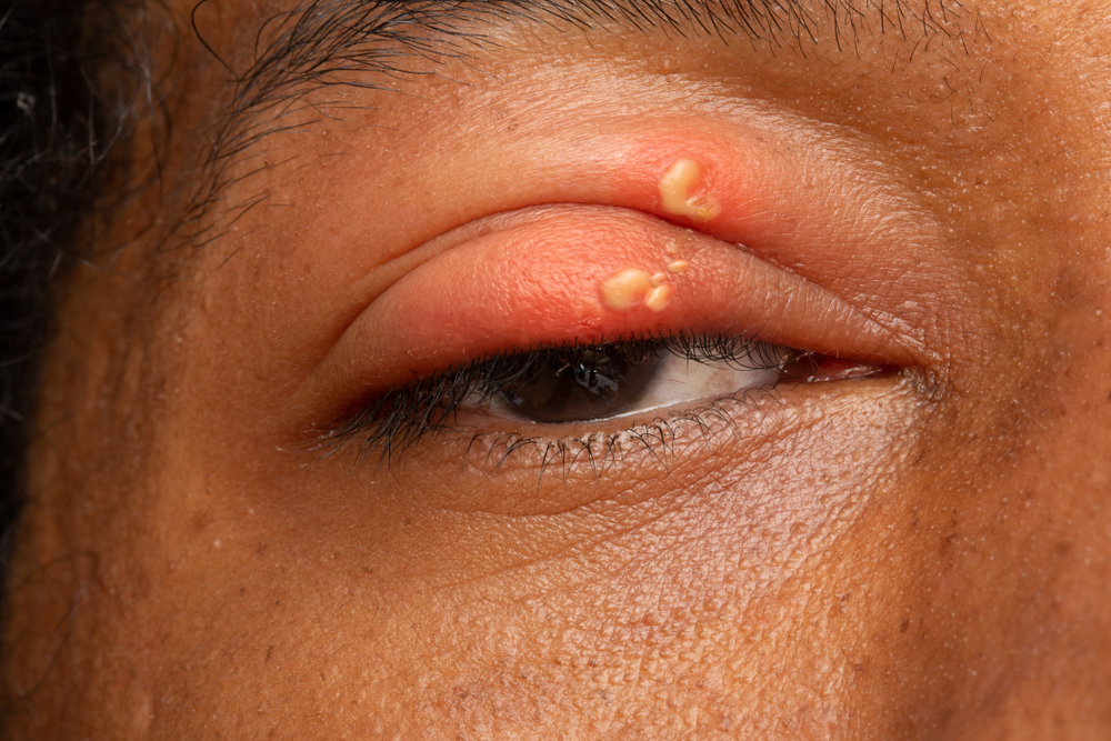 herpes