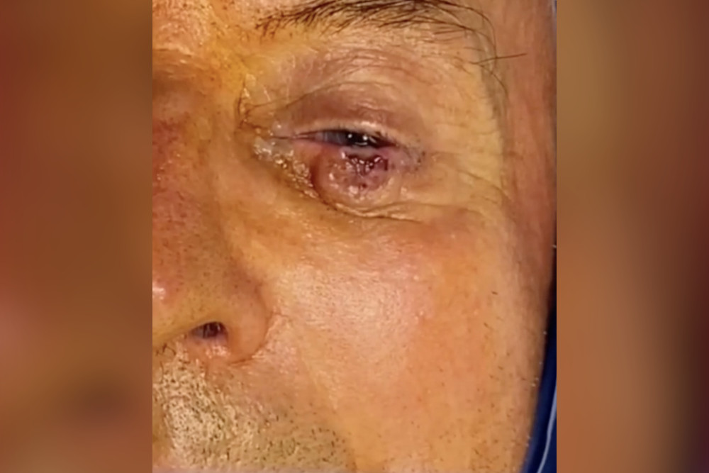 Rimozione carcinoma squamoso della palpebra inferiore_featured image