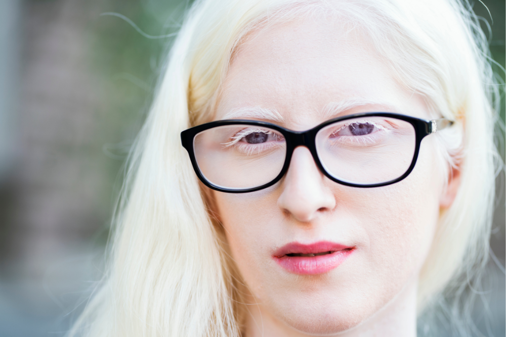 albinismo oculare