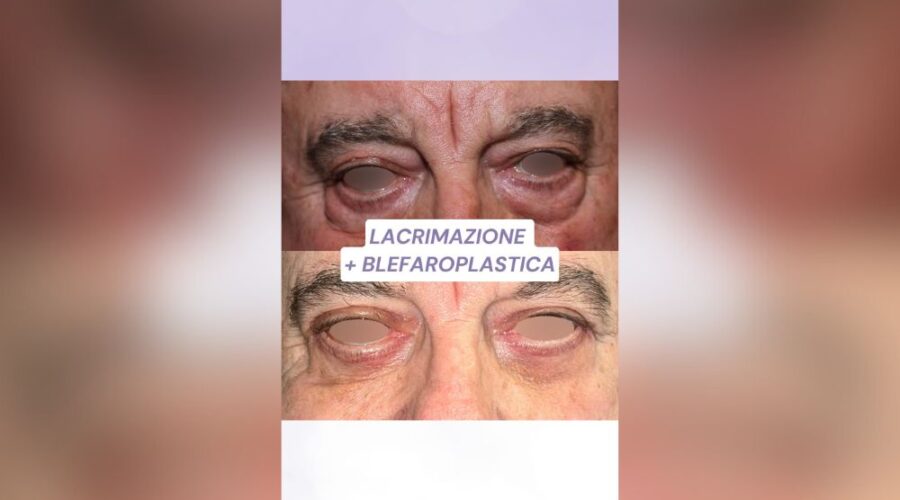 Risolto Lacrimazione Cronica e Migliorato l'Estetica Oculare