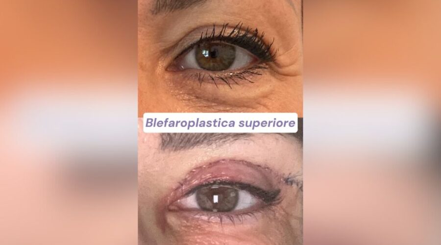 Blefaroplastica La Mia Esperienza e Risultati Dopo 3 Settimane