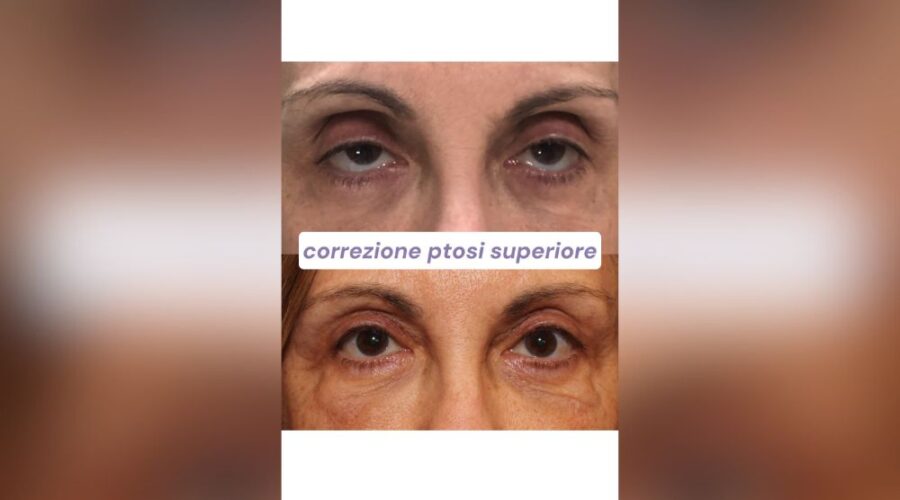 Come Valutare e Correggere l'Eccesso Cutaneo
