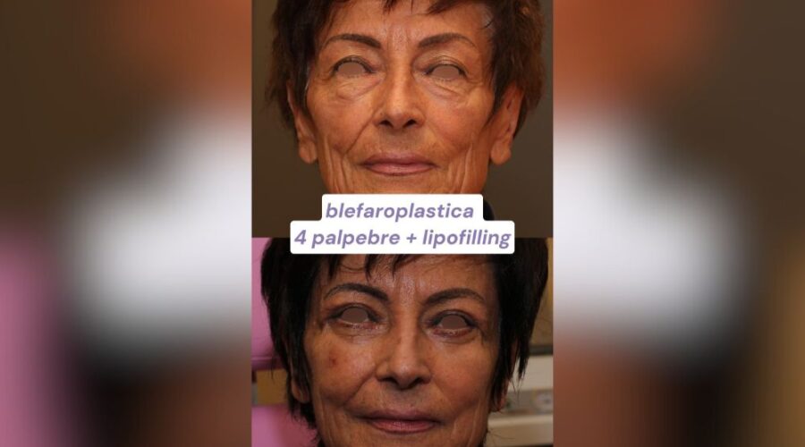 Ringiovanimento Viso Completo Blefaroplastica e Lipofilling