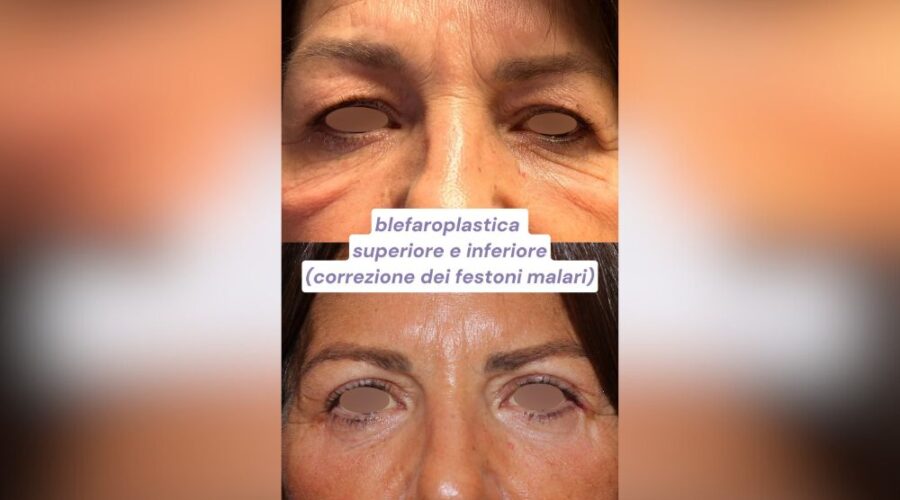 R. Migliardi (Ringiovanire il Tuo Sguardo a 62 Anni Scopri Come con la Blefaroplastica)
