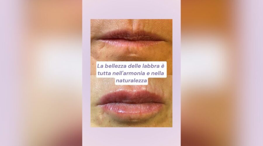 Come Ottenere Labbra Naturali ed Eleganti