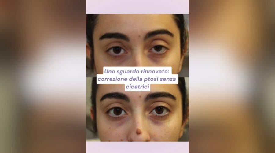 correzione della ptosi senza cicatrici