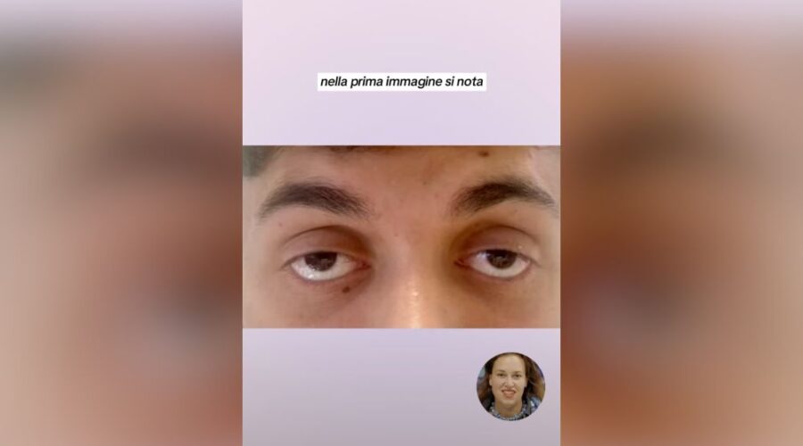 correzione di ptosi e scleral show