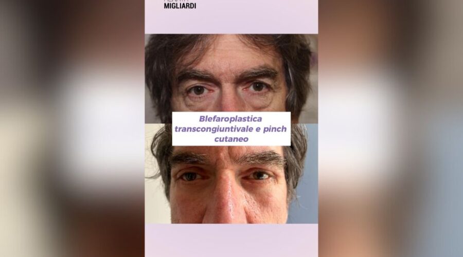 Blefaroplastica transcongiuntivale maschile: ringiovanimento rapido dello sguardo