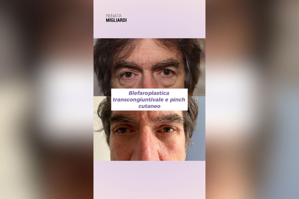 Blefaroplastica transcongiuntivale maschile: ringiovanimento rapido dello sguardo