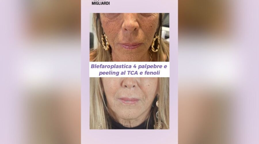 Peeling al TCA e Fenoli Trasforma il Tuo Volto in Una Settimana