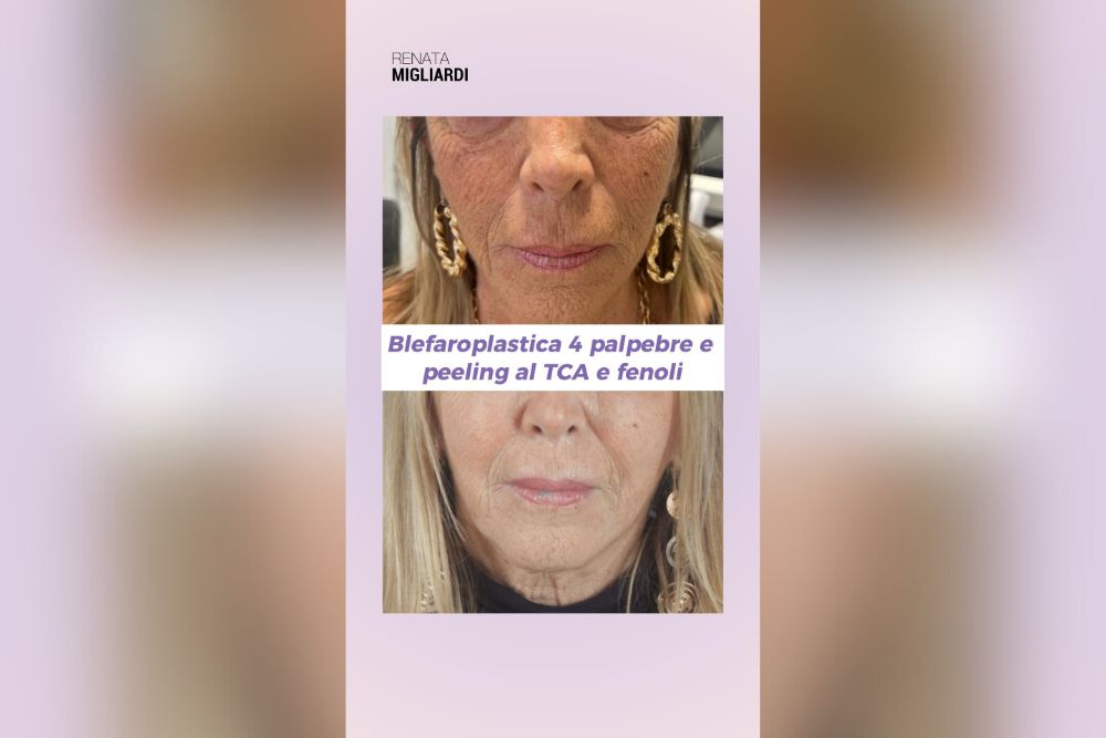 Peeling al TCA e Fenoli Trasforma il Tuo Volto in Una Settimana