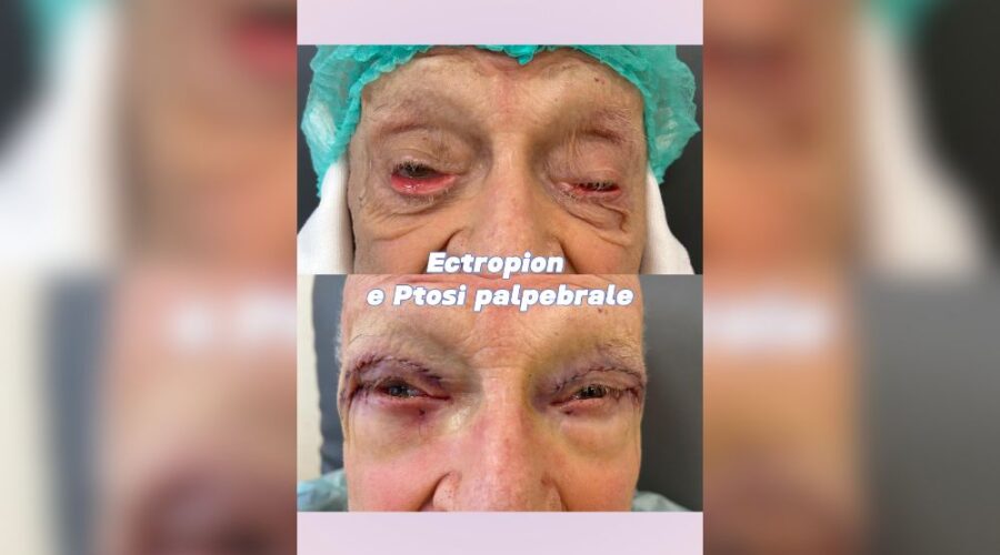 Ectropion e ptosi palpebrale