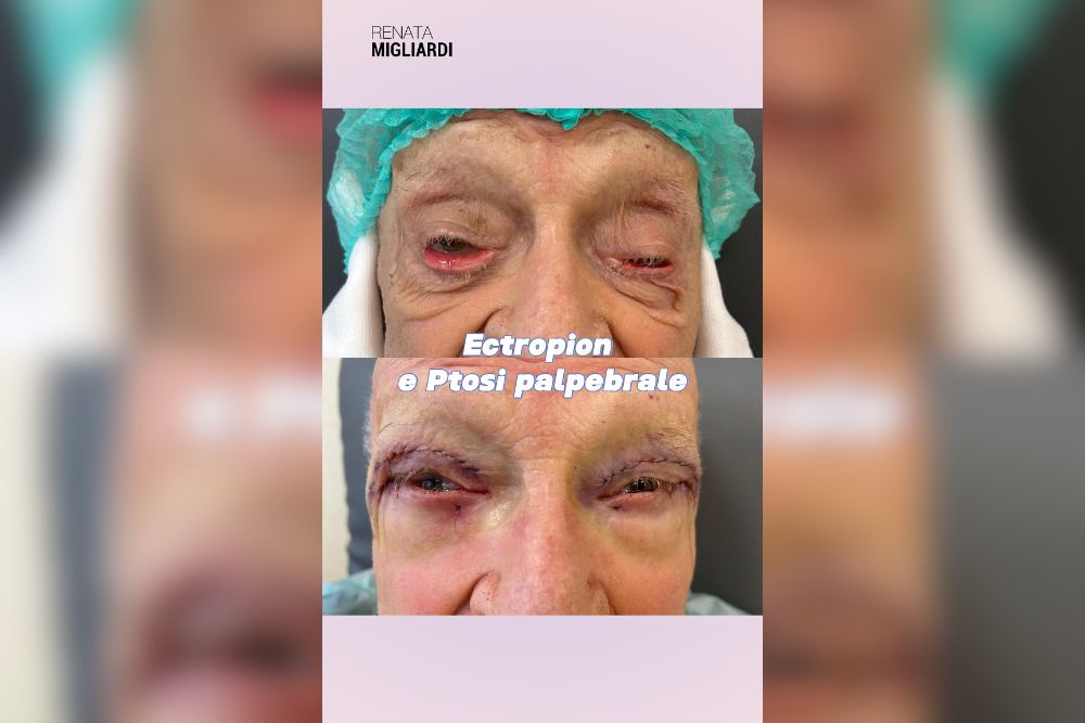 Ectropion e ptosi palpebrale