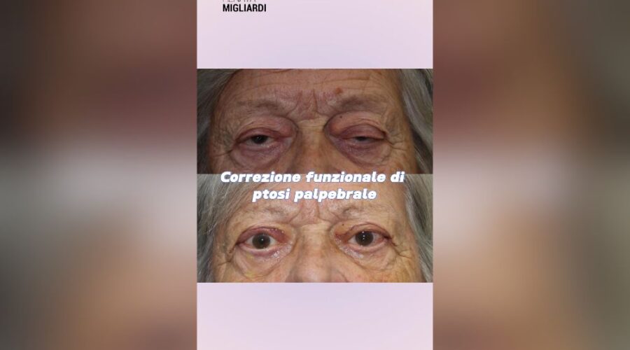 La ptosi palpebrale quando non basta la blefaroplastica