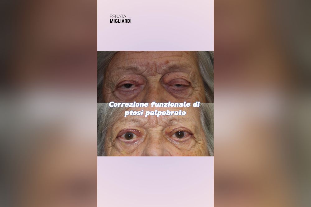 La ptosi palpebrale quando non basta la blefaroplastica