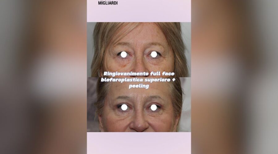 Peeling al TCA e Fenoli trasforma il tuo Volto in una settimana