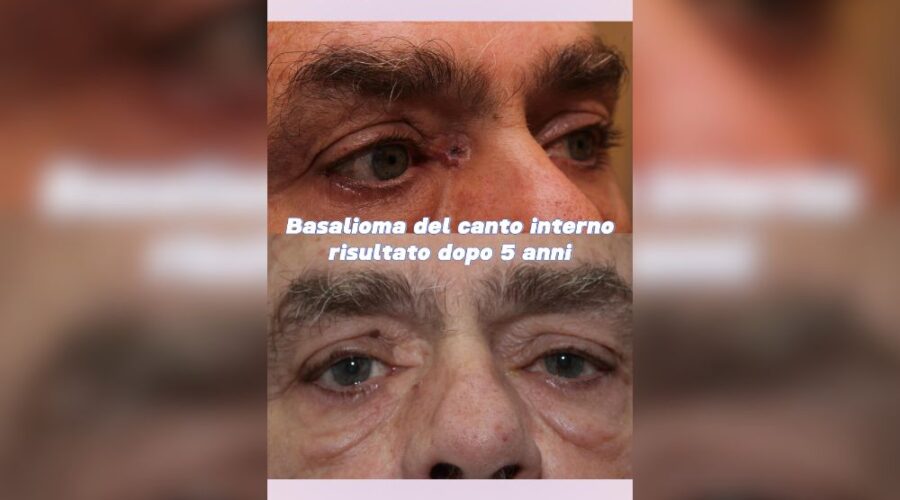 Da Basalioma Palpebrale a Occhio Perfetto Intervento e Ricostruzione