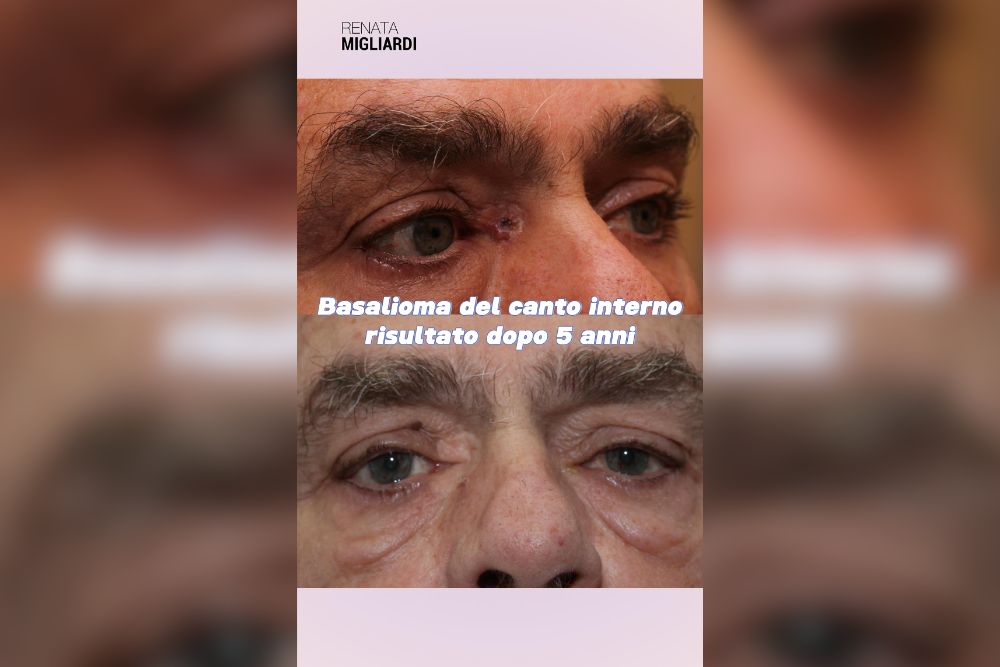 Da Basalioma Palpebrale a Occhio Perfetto Intervento e Ricostruzione