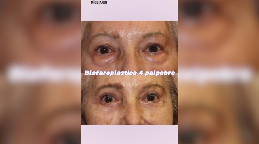 Blefaroplastica 4 Palpebre