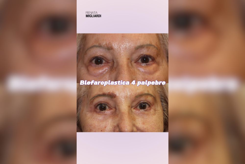 Blefaroplastica 4 Palpebre