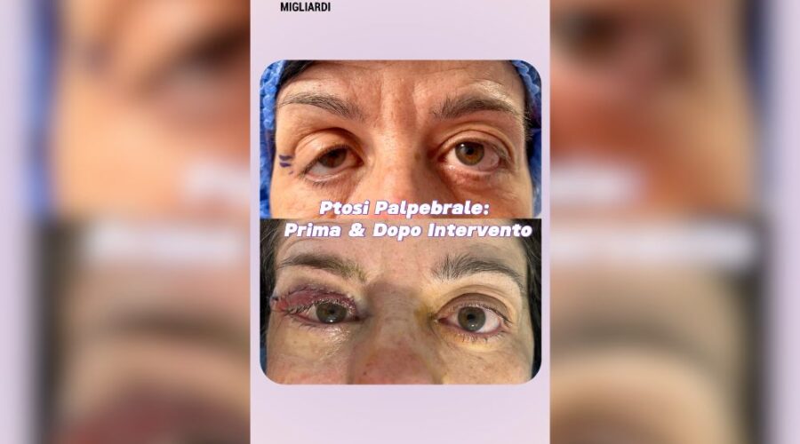 Trasformazione Ptosi Palpebrale Prima & Dopo Intervento