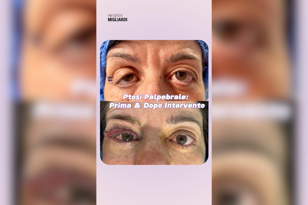 Trasformazione Ptosi Palpebrale Prima & Dopo Intervento