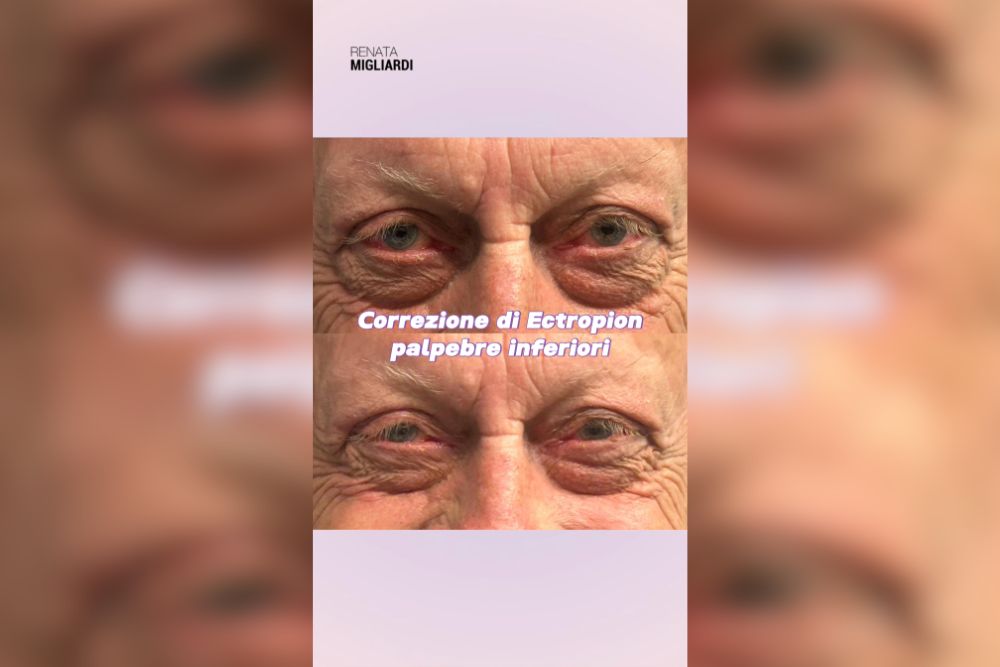 Palpebre cadenti e occhi sempre irritati
