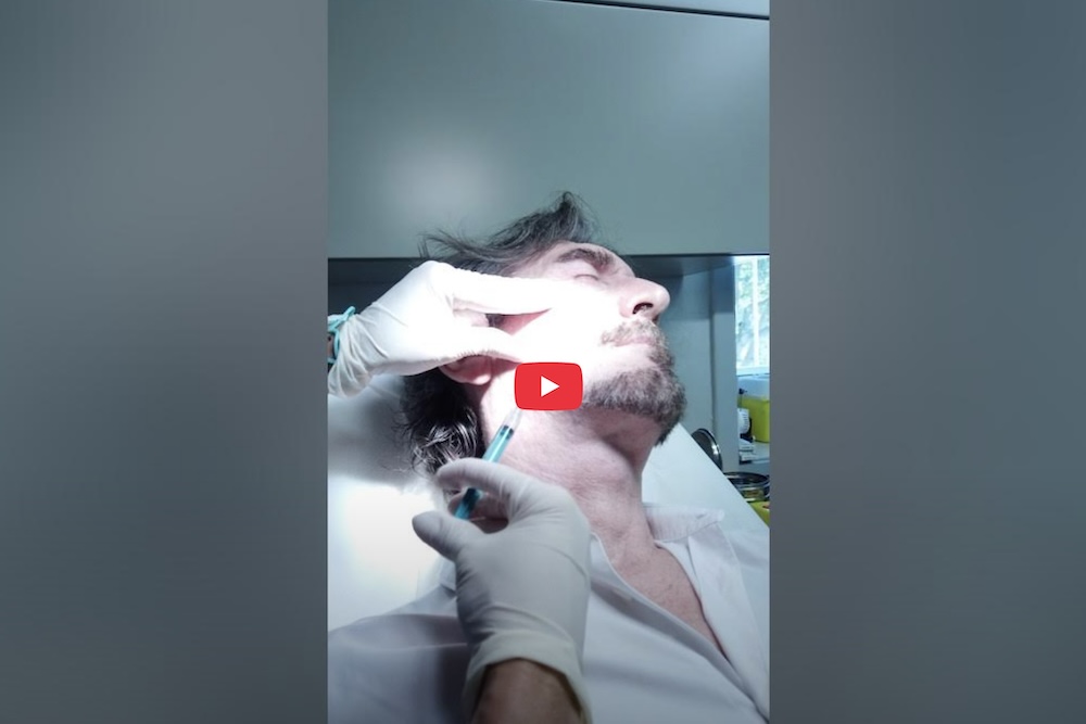 Trattamento viso uomo con acido polilattico (PLLA)