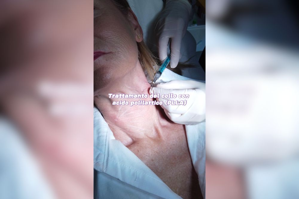 Trattamento mirato del collo con acido polilattico PLLA
