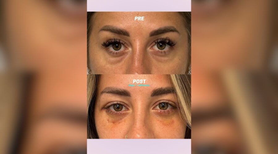 Blefaroplastica in paziente giovane