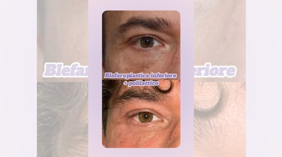 Blefaroplastica inferiore acido polilattico trattamento combinato