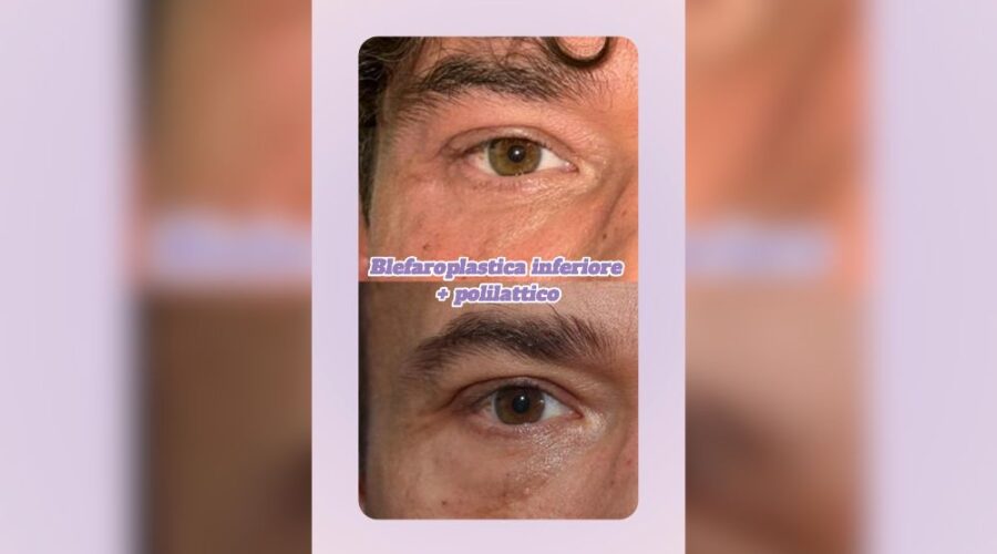 Blefaroplastica inferiore + acido polilattico trattamento combinato