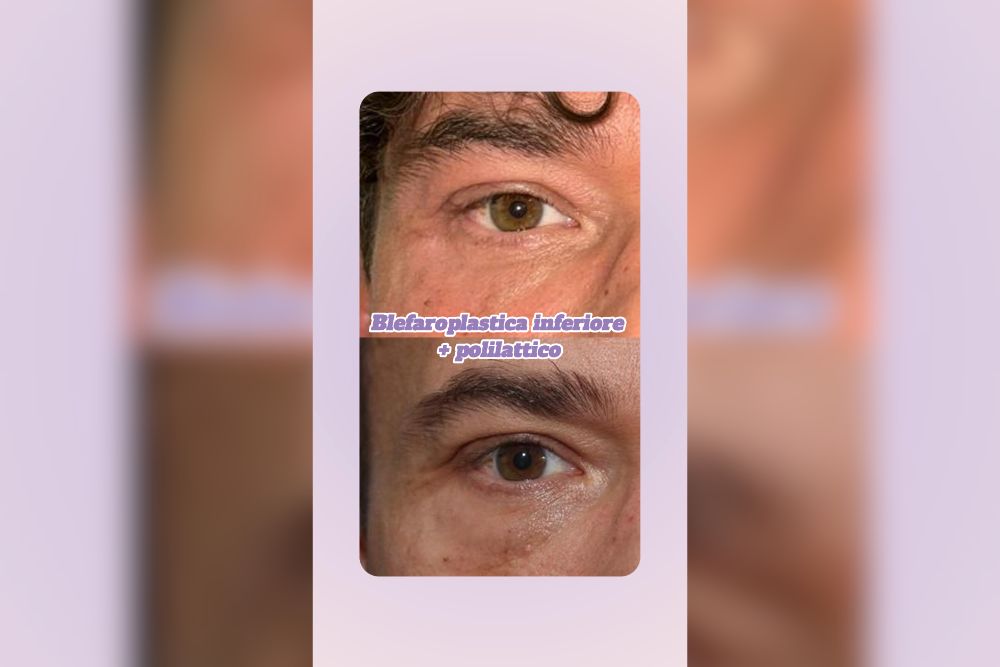 Blefaroplastica inferiore + acido polilattico trattamento combinato