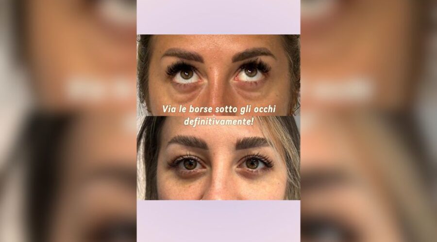 Blefaroplastica dallo sguardo stanco a quello riposato