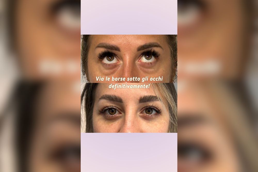 Blefaroplastica dallo sguardo stanco a quello riposato