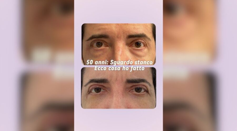 Borse sotto gli occhi e sguardo stanco quando lui non si piace